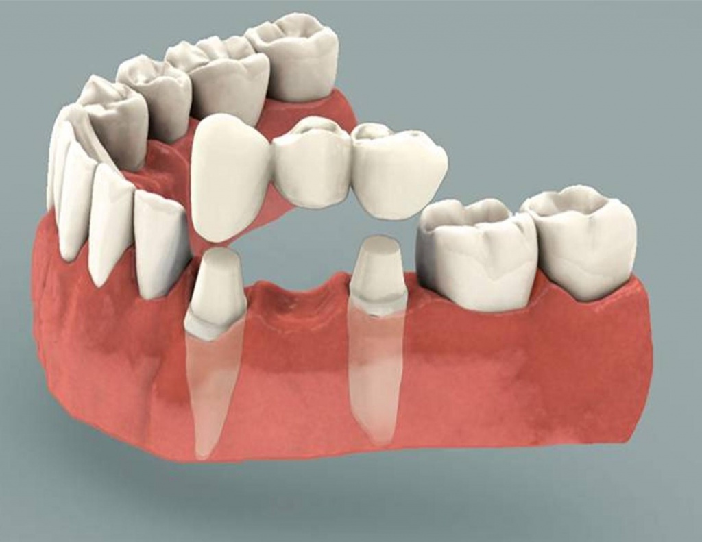 Несъёмные зубные протезы